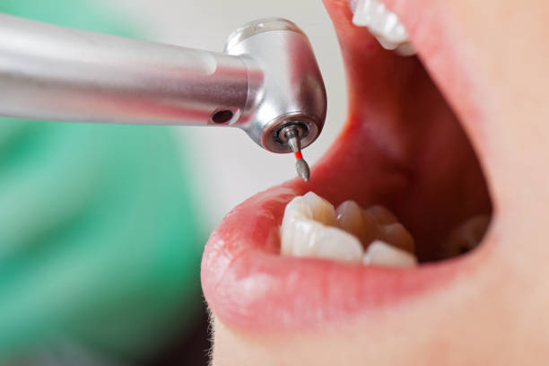 Best Emergency Dental Extractions in Round Lake Heights, IL